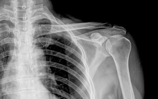 Upside of a broken shoulder